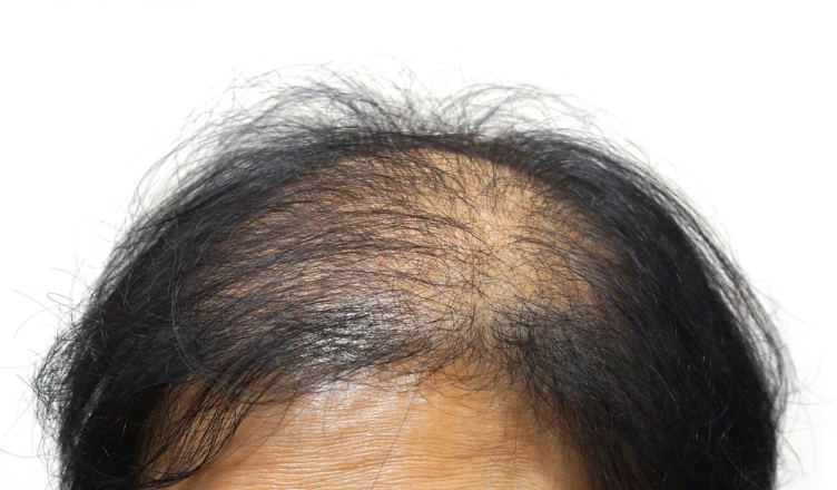Alopecia androgenética